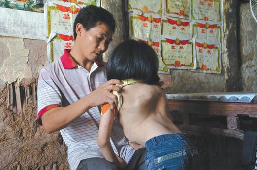 有嚴(yán)重脊椎畸形及胸腔隆突病的李文霞。