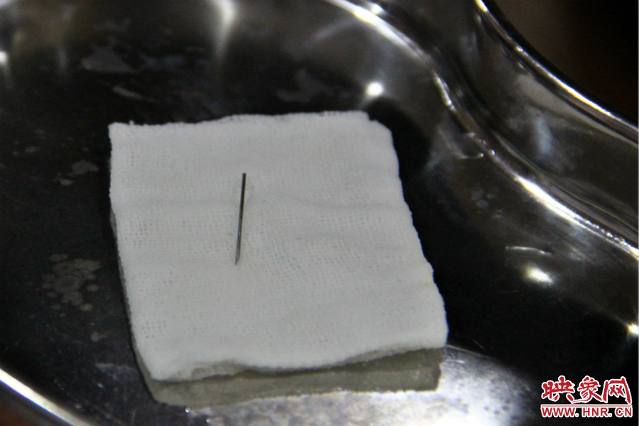 上午11點30分許，小龍腦中鋼針已經(jīng)成功取出。