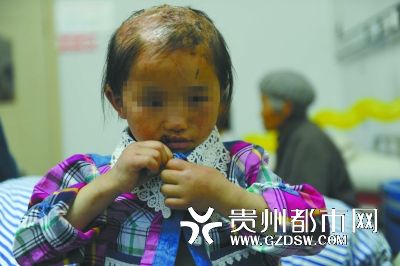 被燙傷的頭皮一直沒有愈合。