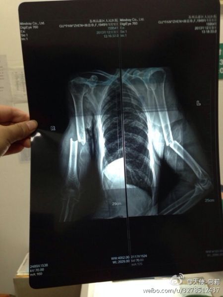 圖為微博上傳“范某某的妻子顧盤珍手被打斷。”