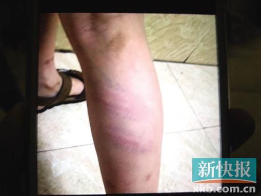 小宇腿部有明顯瘀痕。 翻拍自家屬手機(jī)