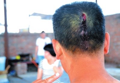 崔先生頭部受傷。京華時(shí)報(bào)記者趙思衡攝/視頻