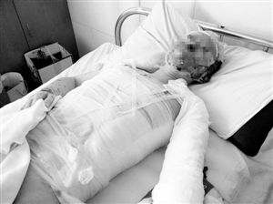 周小姐的頭、頸、軀干、四肢均被燒傷，其中面部燒傷最為嚴(yán)重。