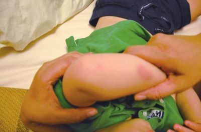 孩子身上有多處明顯傷痕。京華時報讀者供圖