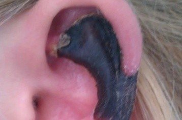 荷蘭女子旅游途中被蜘蛛咬，耳軟骨溶解變黑。