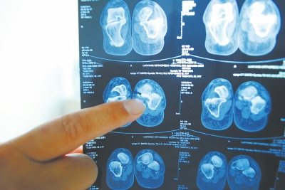 X光片顯示,確實有一根殘留的螺絲釘。