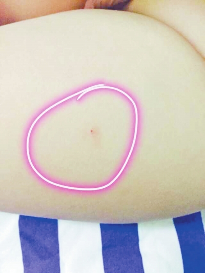 幼兒身上的“針點狀銳器傷”傷痕