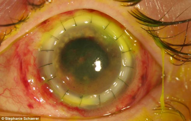 恐怖慎入！隱形眼鏡致英女子摘除眼球