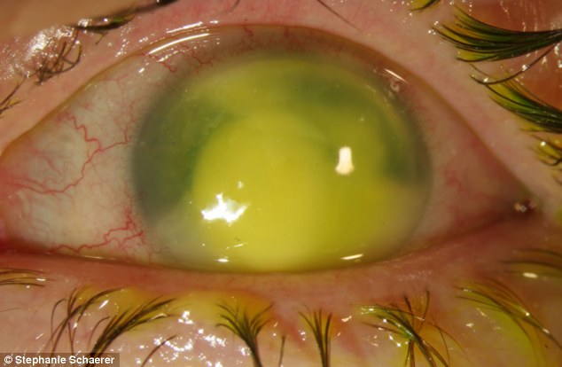 恐怖慎入！隱形眼鏡致英女子摘除眼球