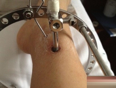 矯正"O型腿"手術全過程