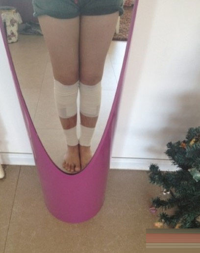 矯正"O型腿"手術全過程