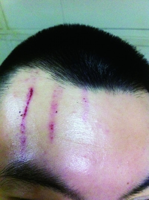 　2013年，被打者受傷照