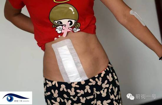 小金腹部的傷口。