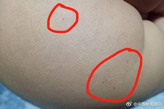 據(jù)多名紅黃藍(lán)(新天地分園)家長反映，孩子腿部、屁股、腋下出現(xiàn)針眼。
