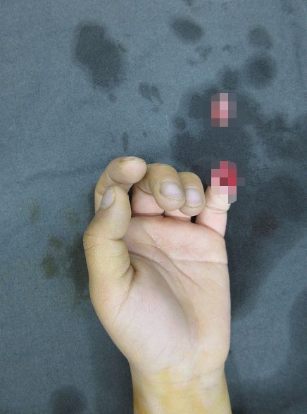 嚇哭！6歲男孩被夾斷手指 罪魁禍?zhǔn)拙故切７? oldsrc=