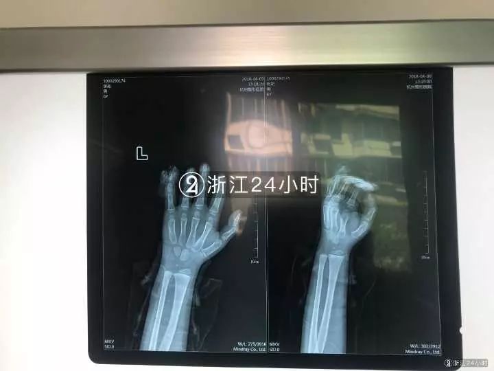 嚇哭！6歲男孩被夾斷手指 罪魁禍?zhǔn)拙故切７? oldsrc=