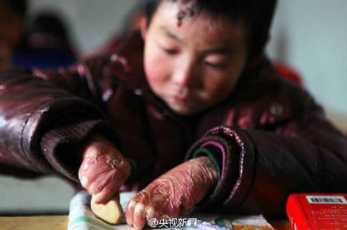 男孩皮膚一碰就破 裹衛(wèi)生紙堅(jiān)持上學(xué) 男孩皮膚一碰就破 裹衛(wèi)生紙堅(jiān)持上學(xué)