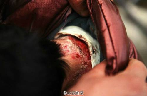 男孩皮膚一碰就破 裹衛(wèi)生紙堅(jiān)持上學(xué) 男孩皮膚一碰就破 裹衛(wèi)生紙堅(jiān)持上學(xué)