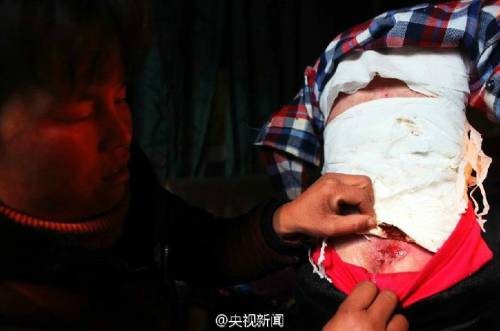 男孩皮膚一碰就破 裹衛(wèi)生紙堅(jiān)持上學(xué) 男孩皮膚一碰就破 裹衛(wèi)生紙堅(jiān)持上學(xué)