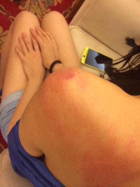 “跑男”真的很拼！baby朋友圈曬后背紅腫照