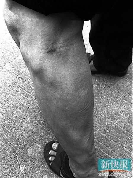 傷者身上遺留的彈痕。