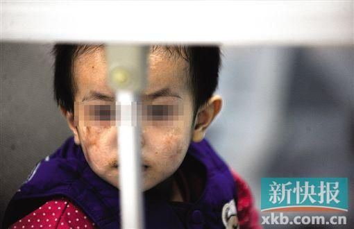 去年3月就能出院的小華(化名),目前還在廣州市婦兒醫(yī)療中心的PICU里住著。新快報記者 孫毅/攝