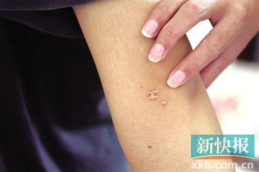 取出針后李星兒手臂留下了傷口。新快報記者 張國鋒/攝