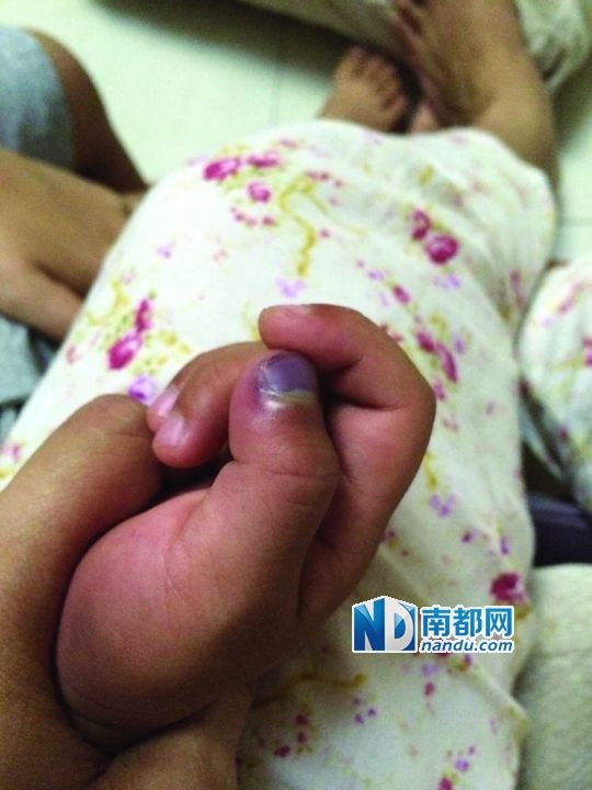 小逸手指被夾傷。