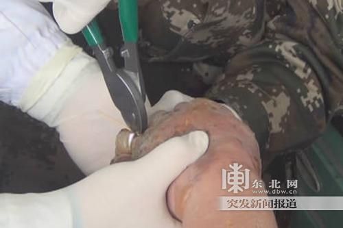 正在拆除戒指。