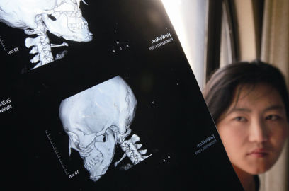 國(guó)內(nèi)醫(yī)院CT顯示，如今靳魏坤的鼻子假體是歪的，連下巴也是歪的