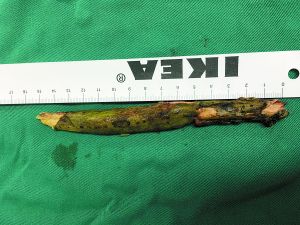 插入男子腦內(nèi)的樹枝。