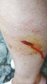 郭女士腿上被猴子咬的傷口。(受訪者供圖)